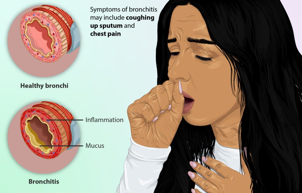 Can Bronchitis Be Treated With Antibiotics