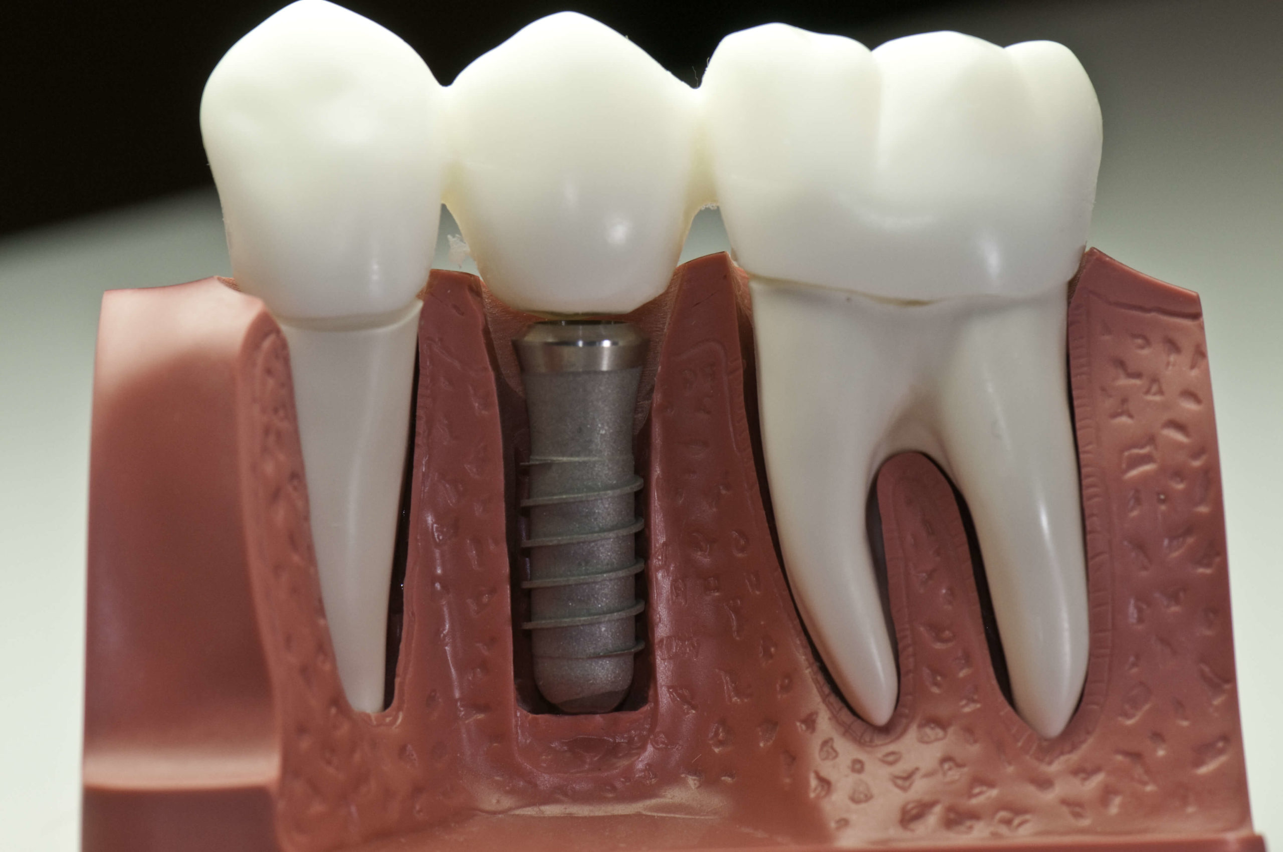 What are ceramic crowns