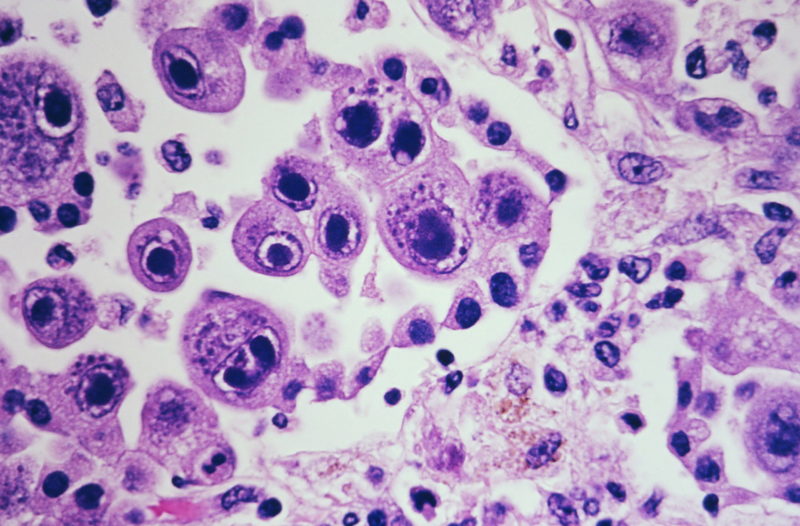 Cytomegalovirus