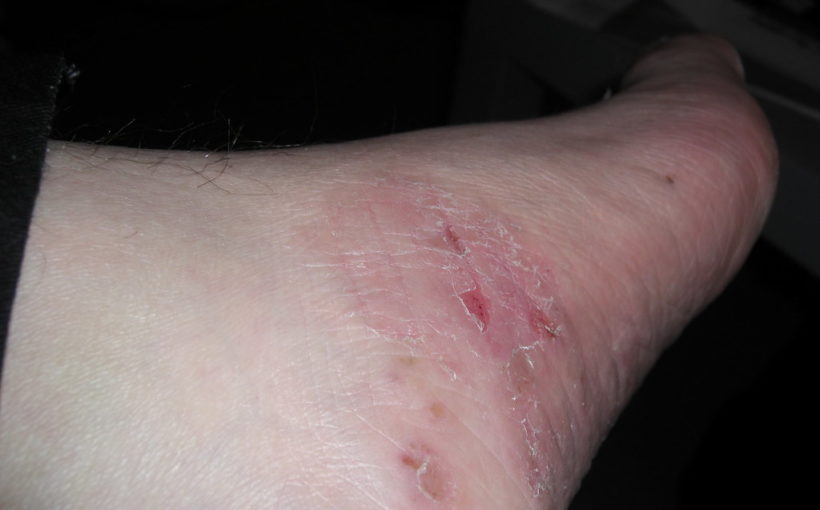 rashes