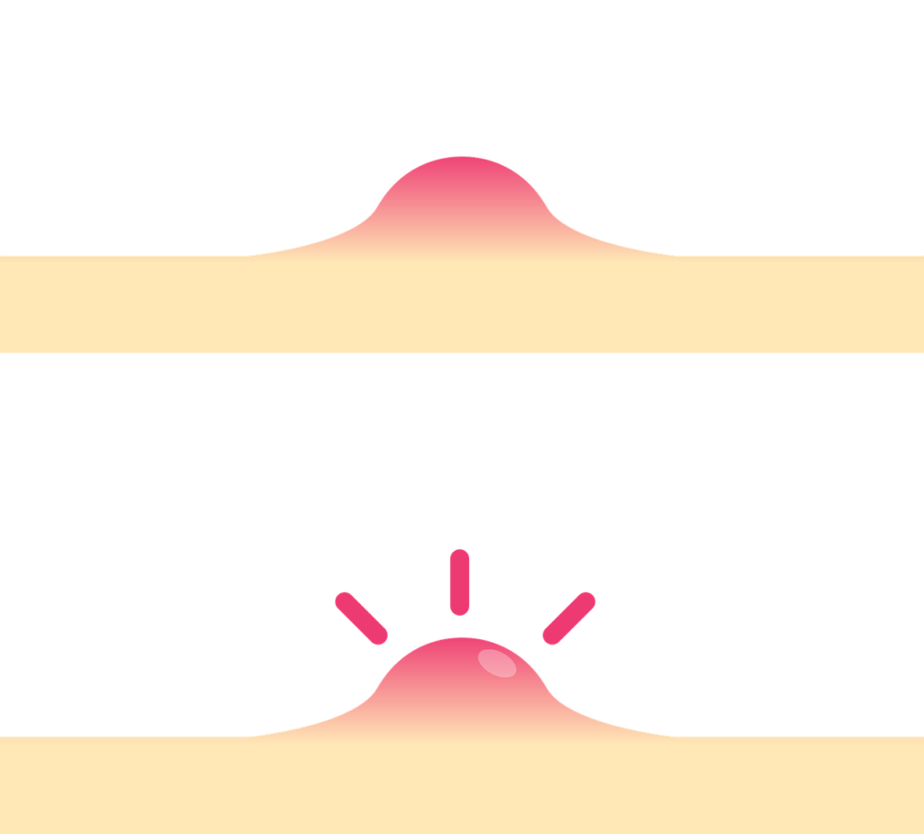 Pilonidal cyst