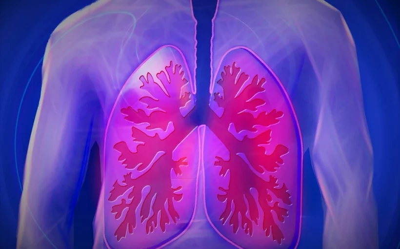 Pneumonia