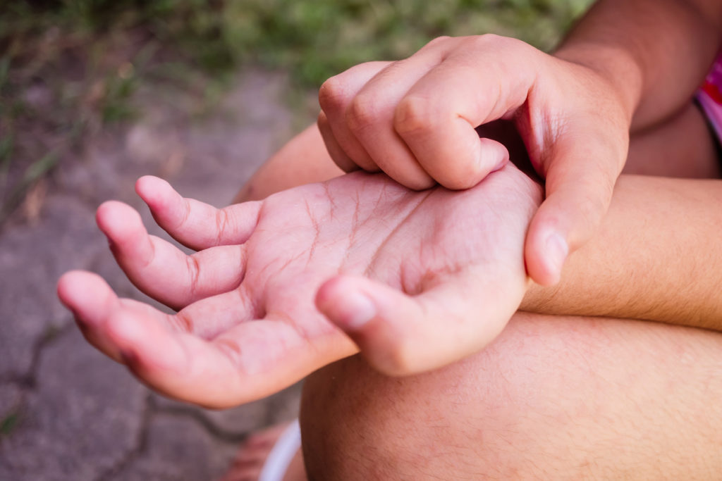 Itchy Hands Can Be a Skin Problem, Not Just a Superstition
