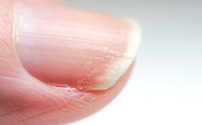 Why Do My Fingernails Curl?