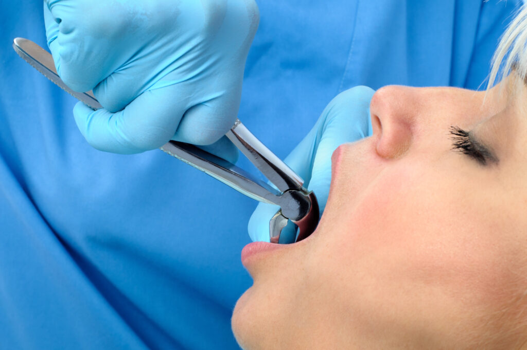 Tooth Extractions: Procedure, Recovery, and Aftercare