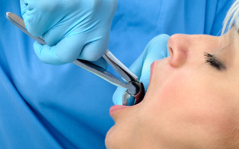 Tooth Extractions: Procedure, Recovery, and Aftercare