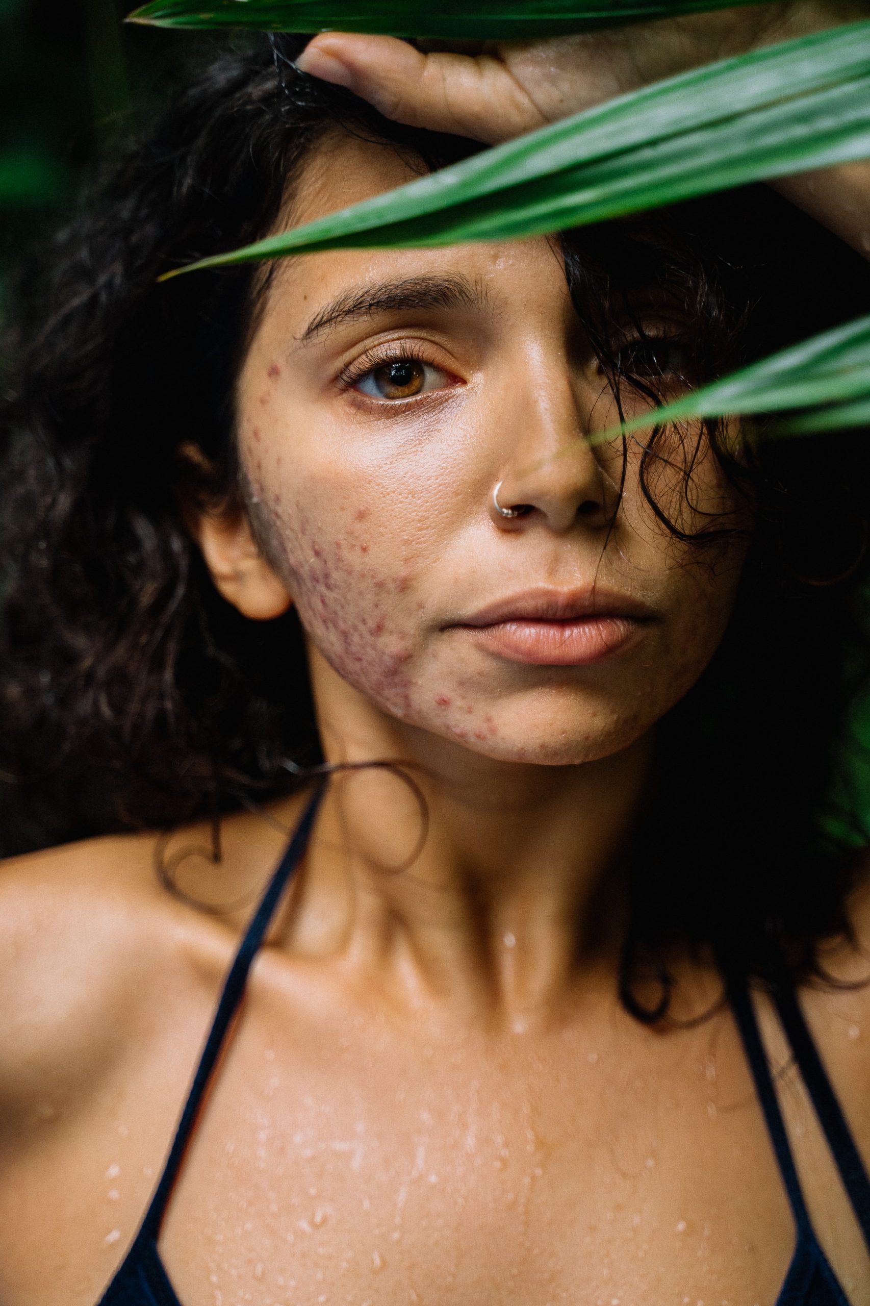 How to Beat Acne at 40 After Accutane