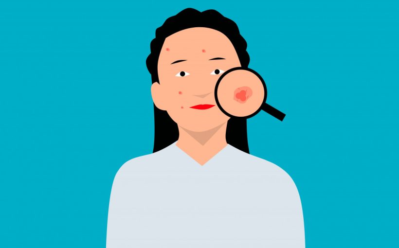 How to Beat Acne at 40 After Accutane